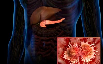  A new radioactive gel wiped out 80% of pancreatic tumors