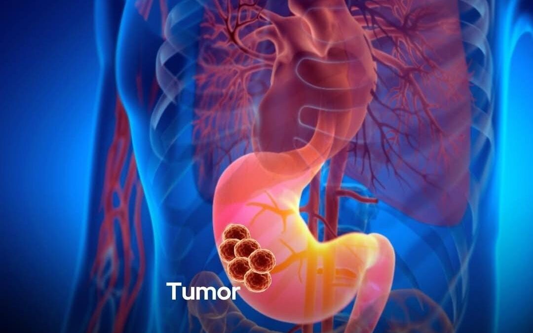 The Influenza flu virus is being used to cure pancreatic cancer