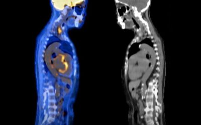 COVID-19 FOUND ACTIVE IN PATIENTS 3 YEARS   AFTER INFECTION