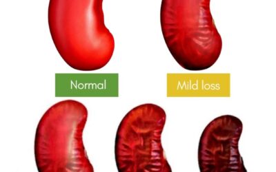 The 5 Stages of Kidney Disease