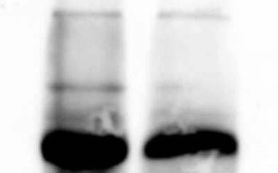 A rare and dangerous autoimmune disorder is being linked to COVID-19