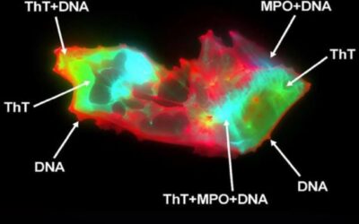 People with long COVID were found to have sticky microclots in their blood